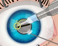 Хирургия глаза